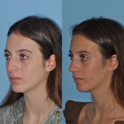 Rhinoplasty Before & After Gallery - Patient 59075285 - Image 4