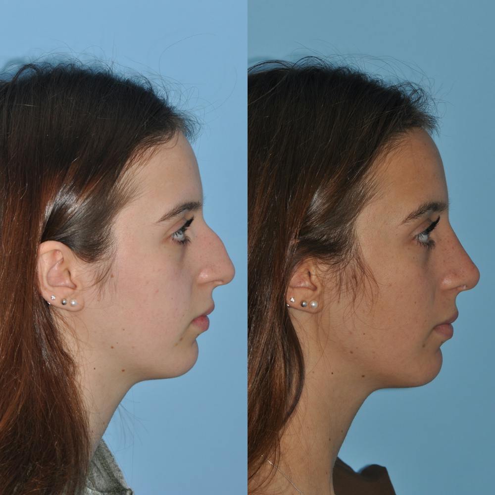 Rhinoplasty Before & After Gallery - Patient 59075285 - Image 6