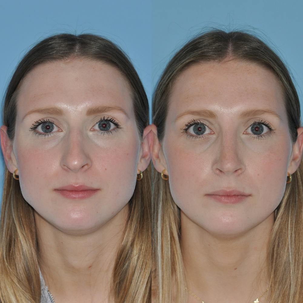 Rhinoplasty Before & After Gallery - Patient 59075286 - Image 1