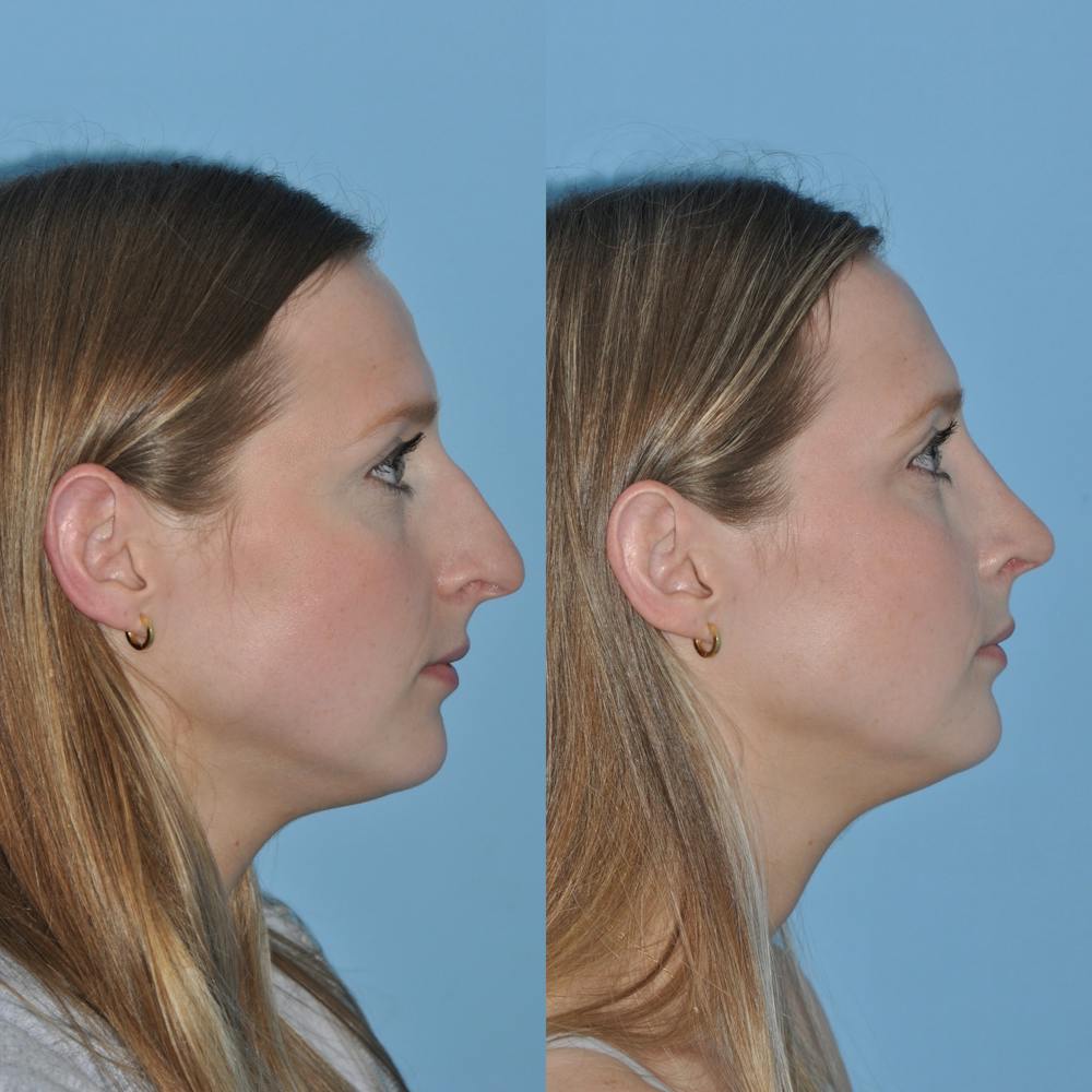 Rhinoplasty Before & After Gallery - Patient 59075286 - Image 3