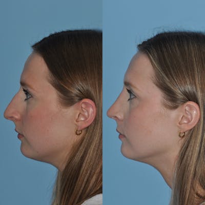 Rhinoplasty Before & After Gallery - Patient 59075286 - Image 4