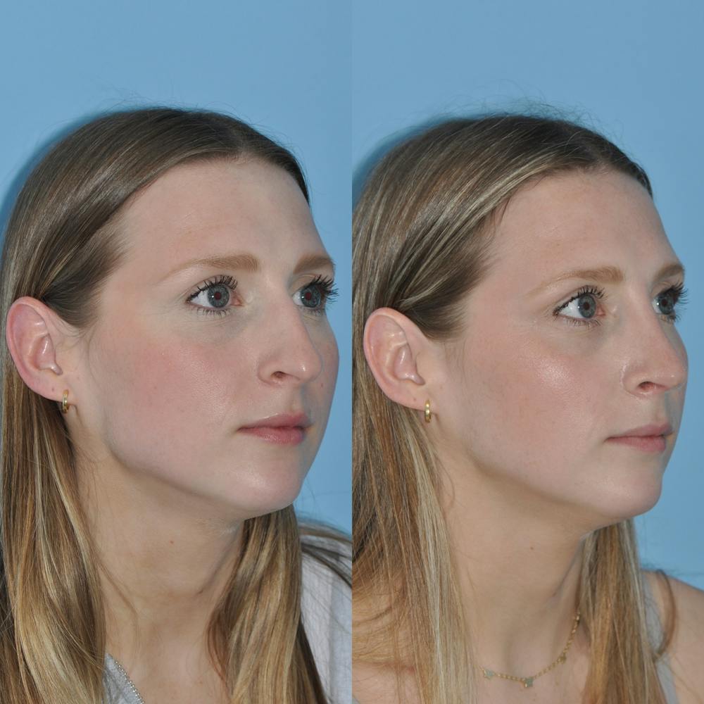 Rhinoplasty Before & After Gallery - Patient 59075286 - Image 5