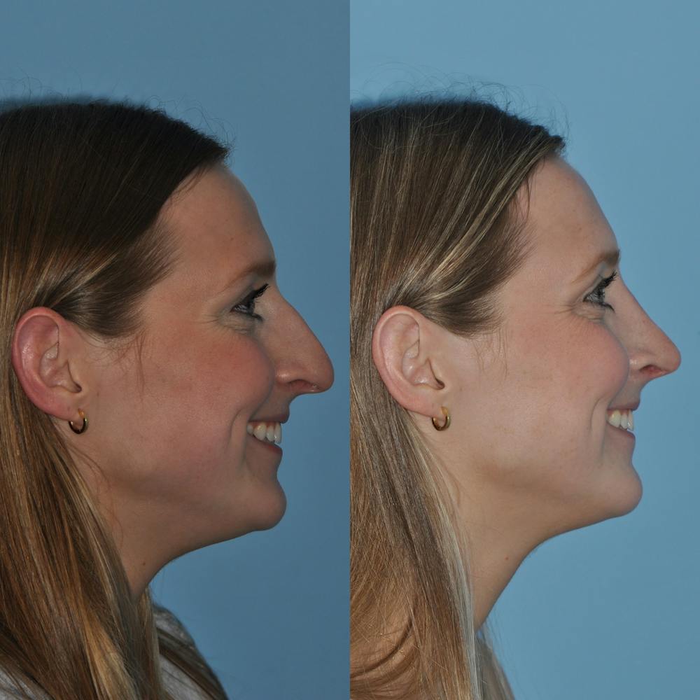 Rhinoplasty Before & After Gallery - Patient 59075286 - Image 6