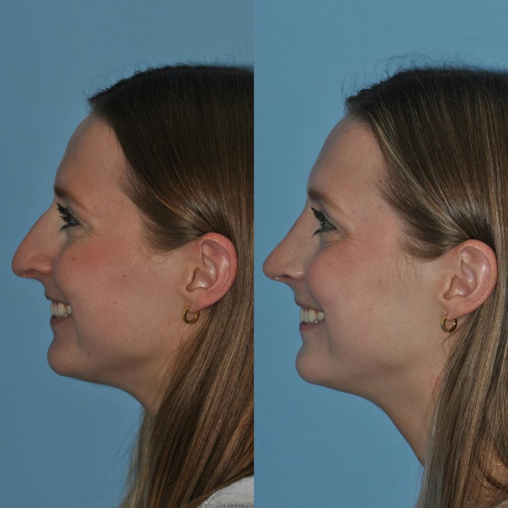 Rhinoplasty Before & After Gallery - Patient 59075286 - Image 7