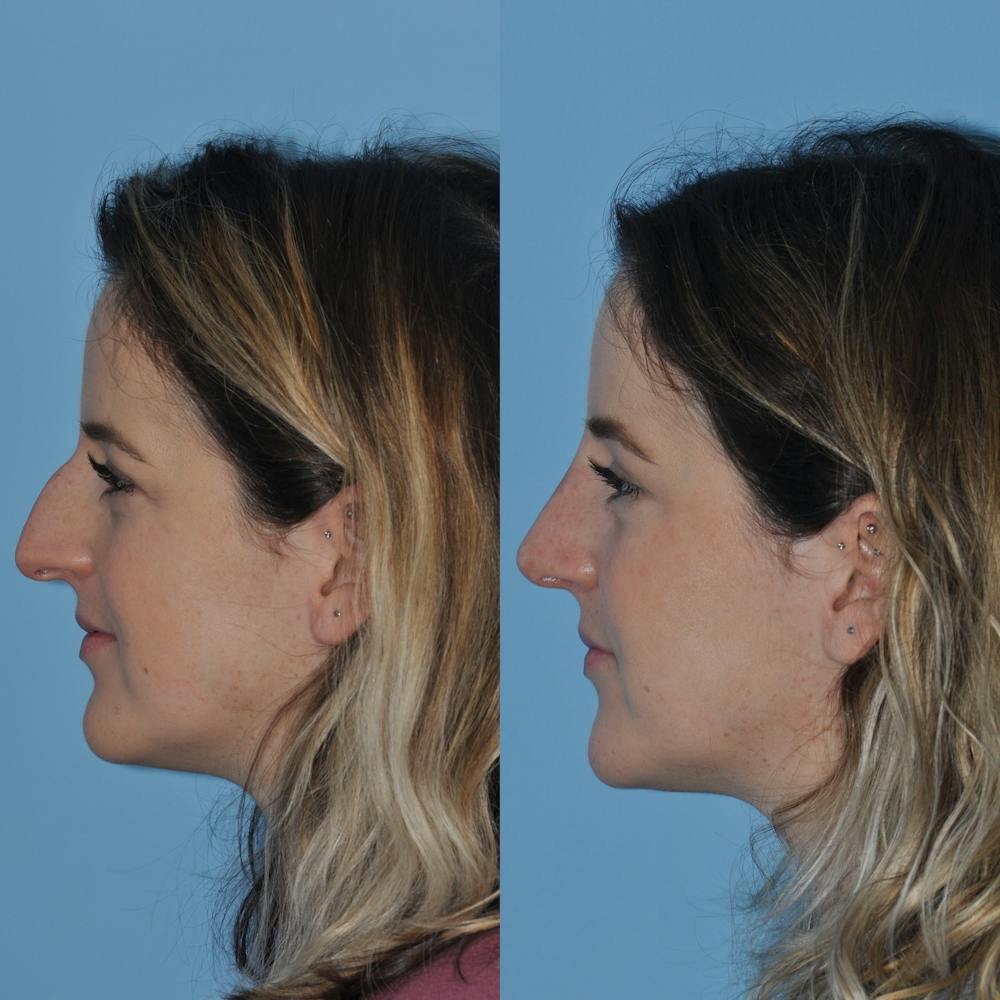 Rhinoplasty Before & After Gallery - Patient 59075287 - Image 1