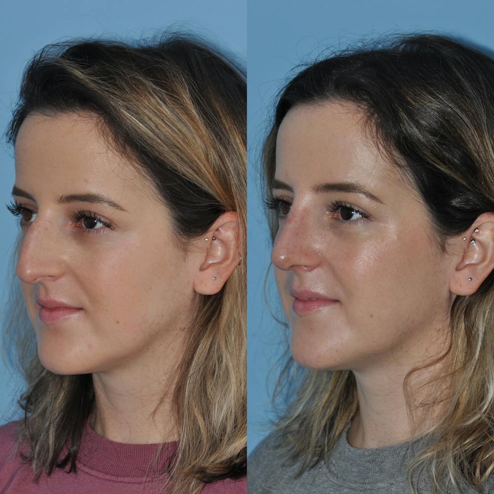Rhinoplasty Before & After Gallery - Patient 59075287 - Image 2