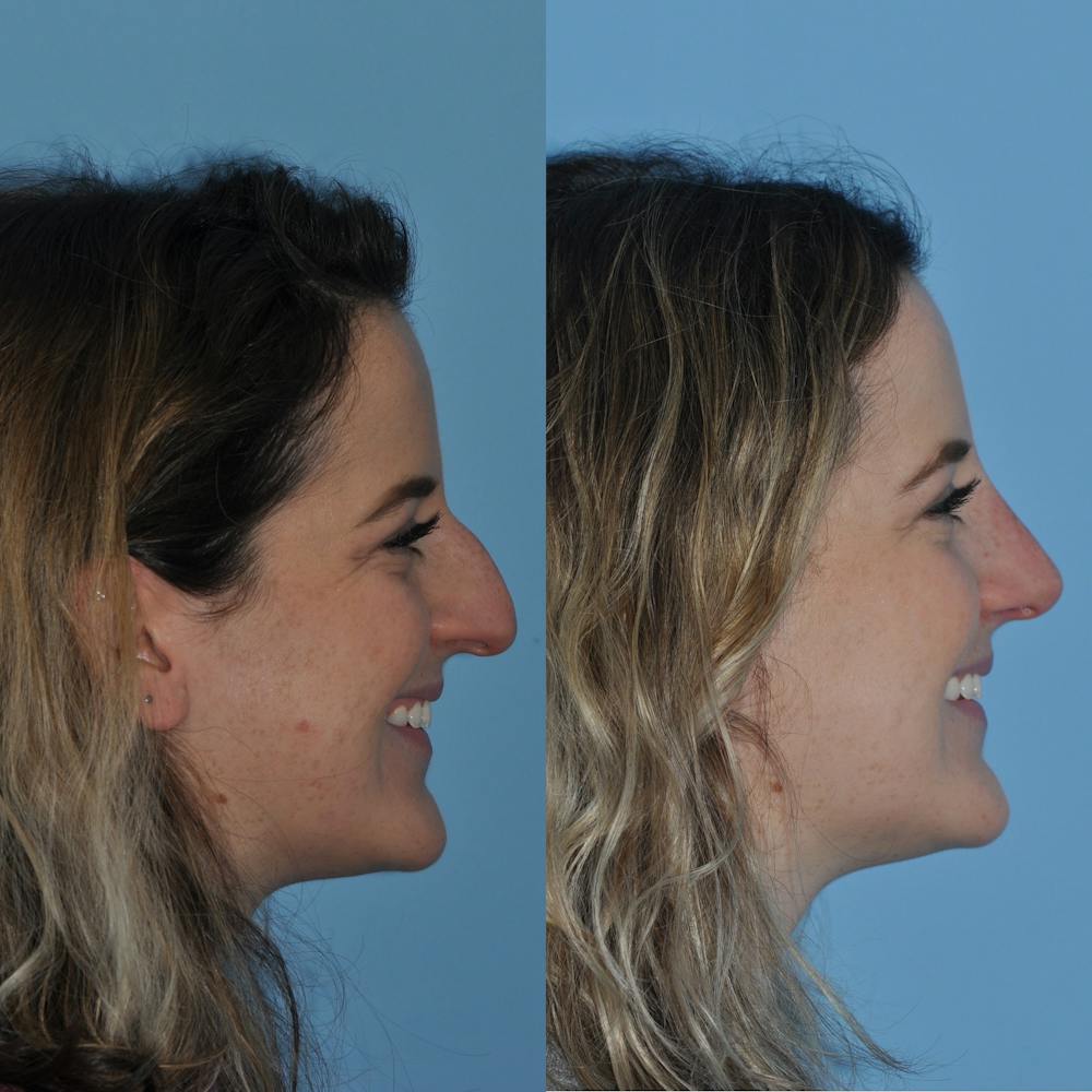 Rhinoplasty Before & After Gallery - Patient 59075287 - Image 3