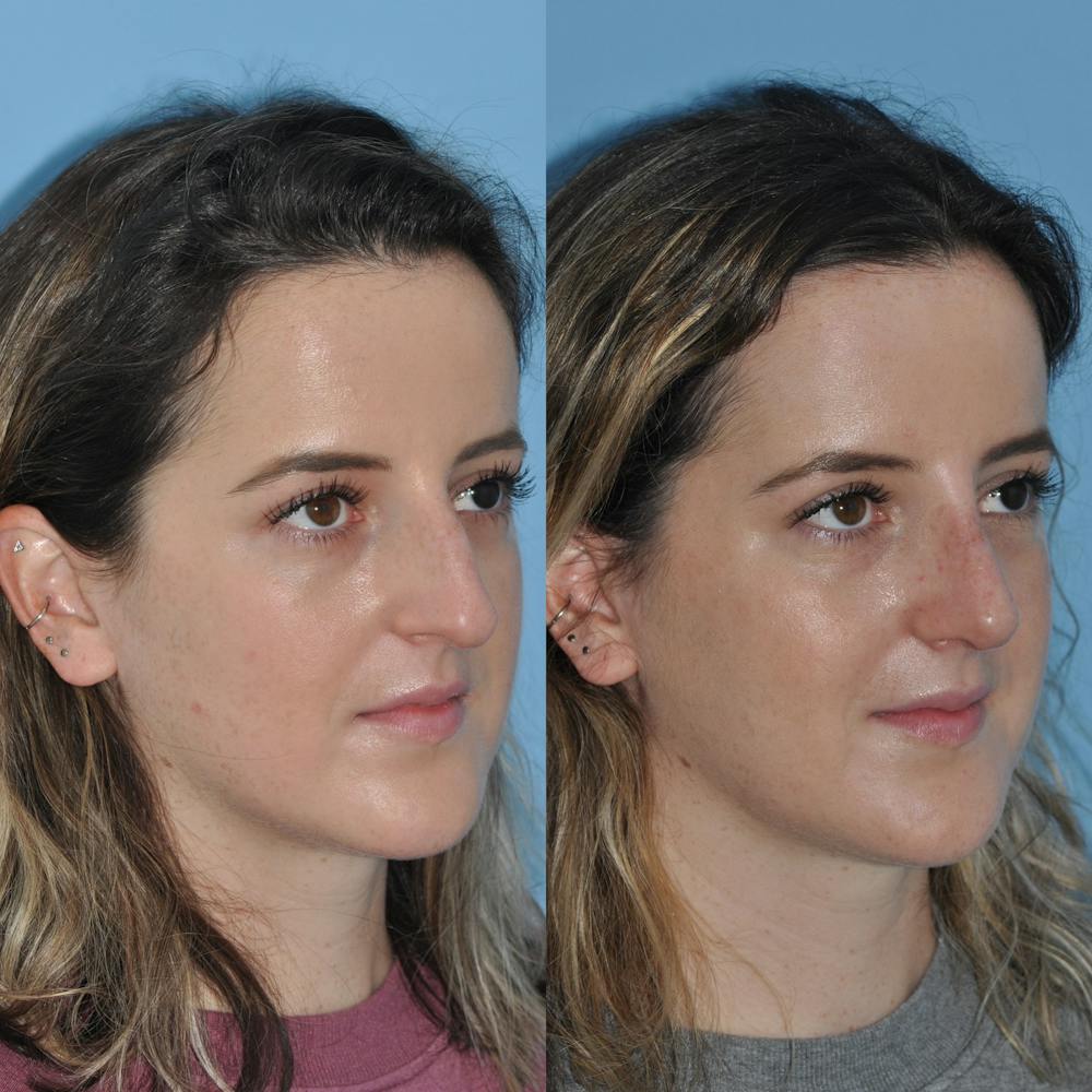 Rhinoplasty Before & After Gallery - Patient 59075287 - Image 4