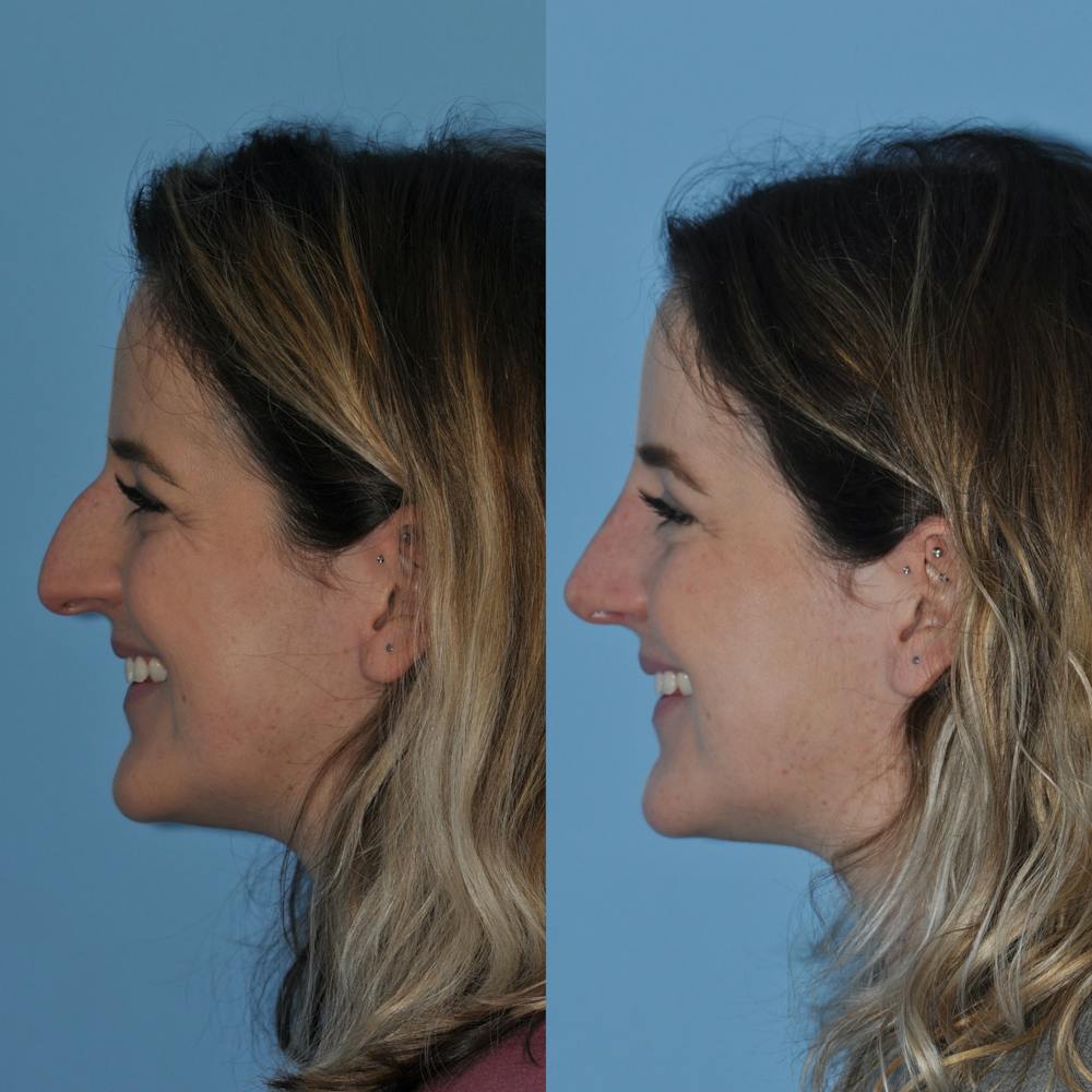 Rhinoplasty Before & After Gallery - Patient 59075287 - Image 6