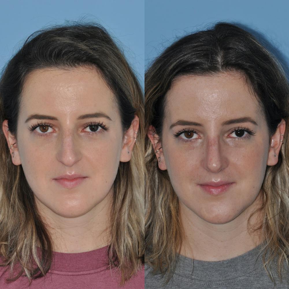 Rhinoplasty Before & After Gallery - Patient 59075287 - Image 7