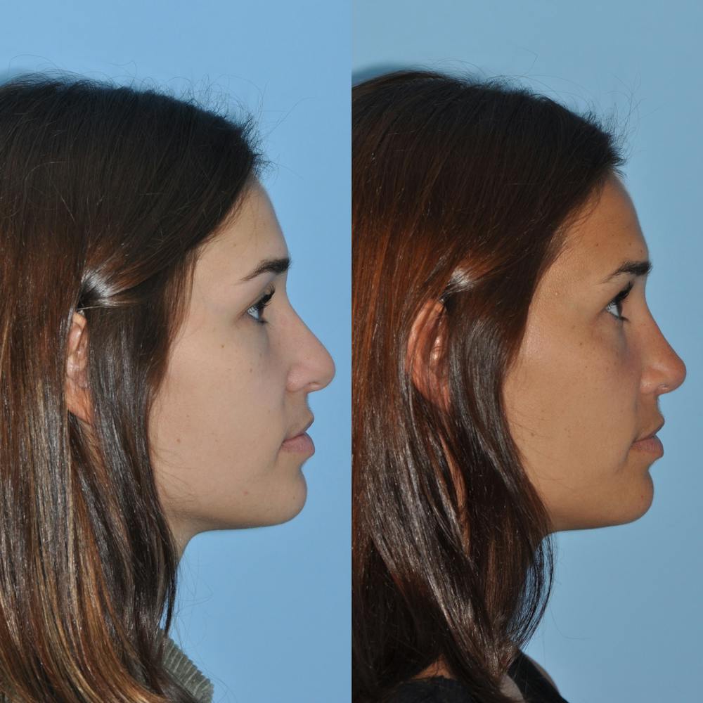 Rhinoplasty Before & After Gallery - Patient 59075288 - Image 3