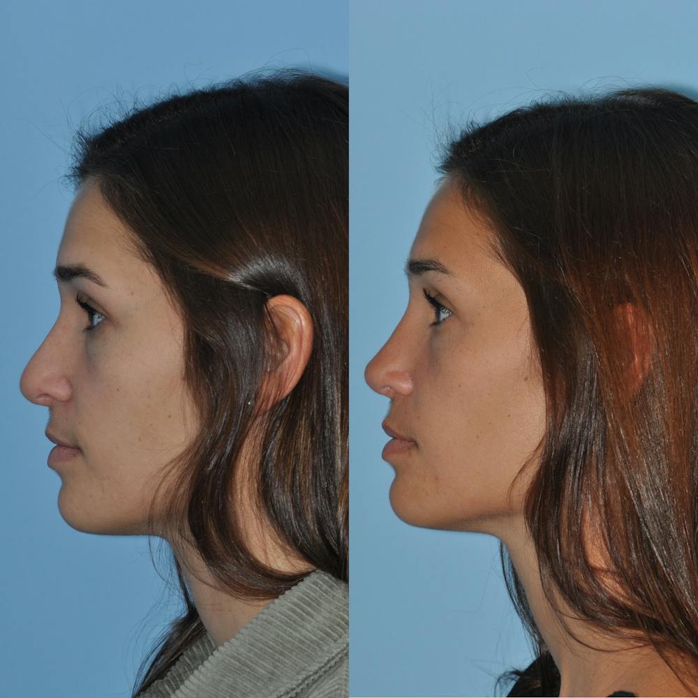 Rhinoplasty Before & After Gallery - Patient 59075288 - Image 5