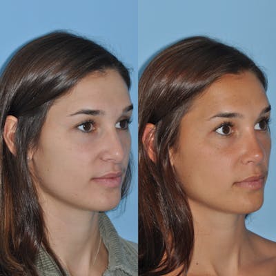 Rhinoplasty Before & After Gallery - Patient 59075288 - Image 6