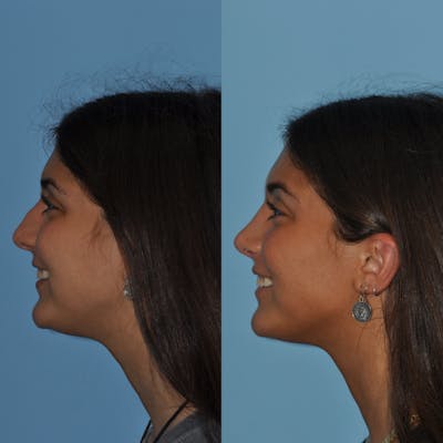 Rhinoplasty Before & After Gallery - Patient 59075289 - Image 2