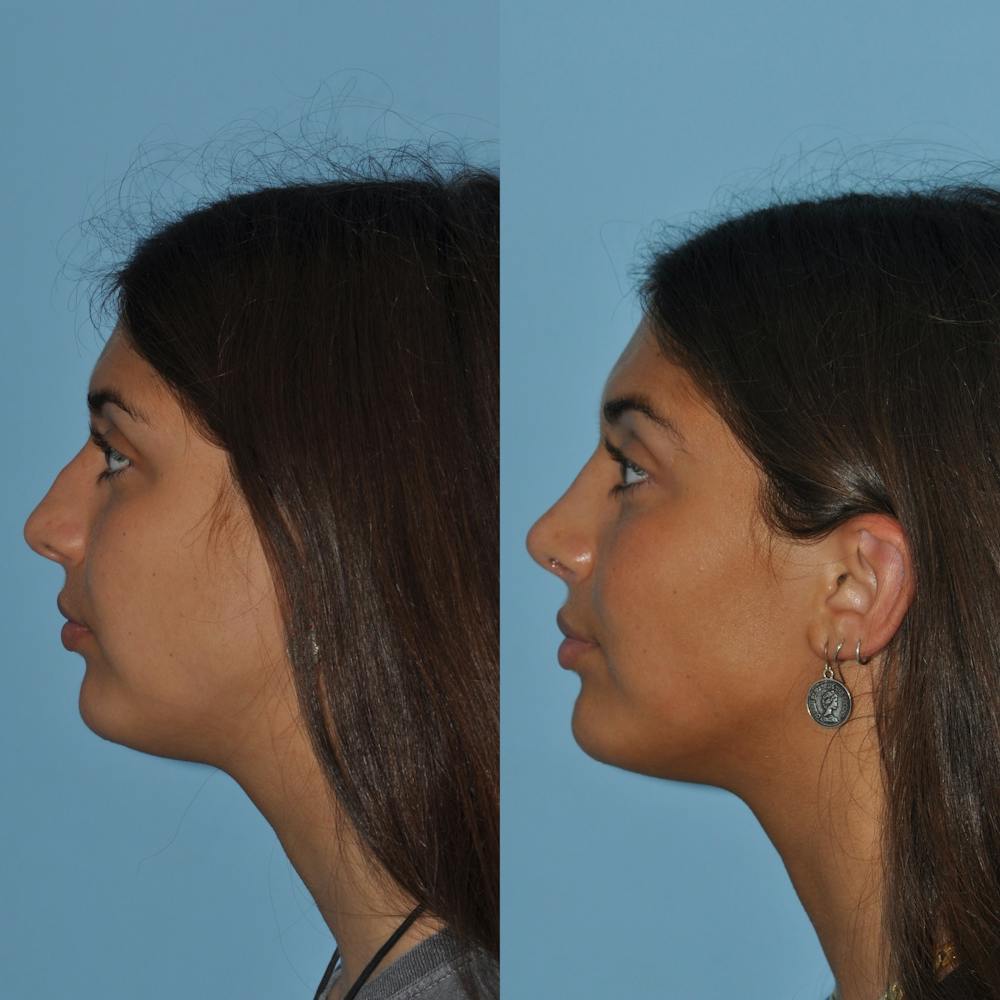 Rhinoplasty Before & After Gallery - Patient 59075289 - Image 3