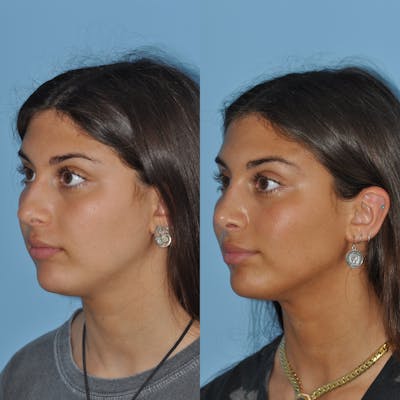 Rhinoplasty Before & After Gallery - Patient 59075289 - Image 4