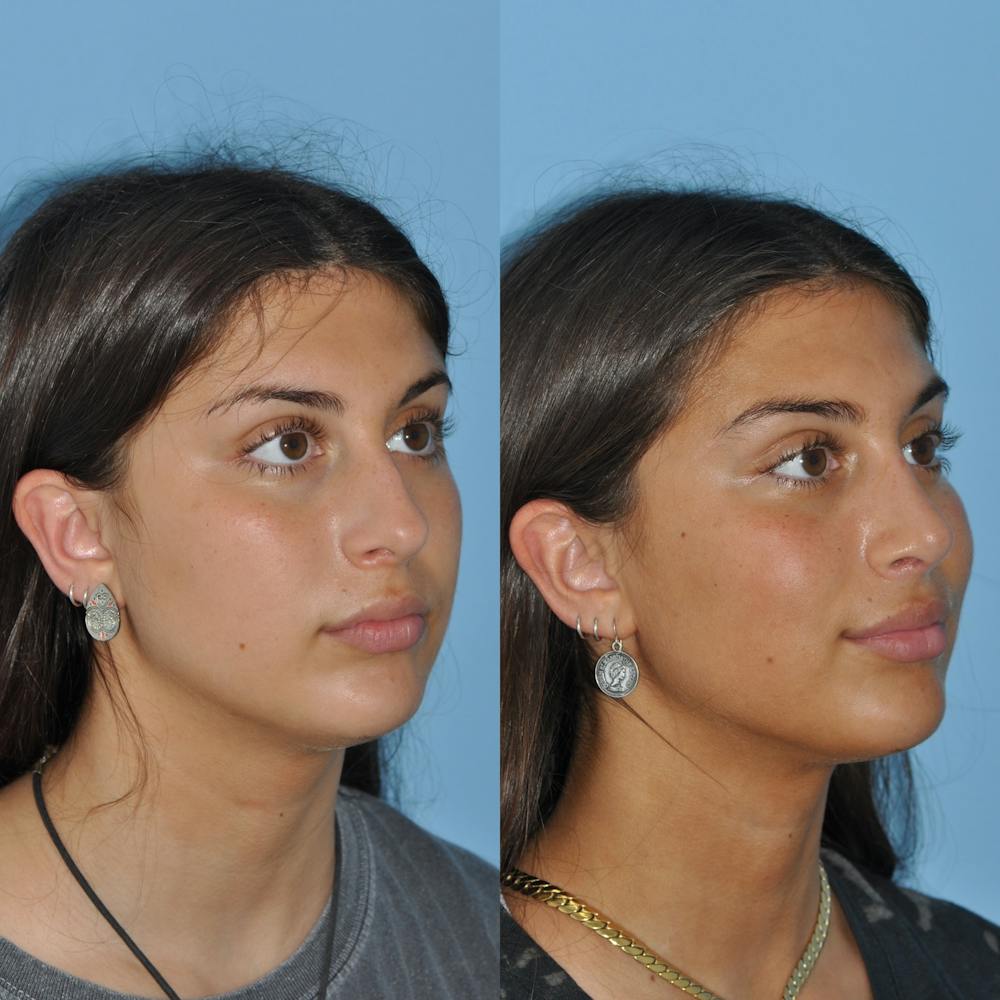 Rhinoplasty Before & After Gallery - Patient 59075289 - Image 5