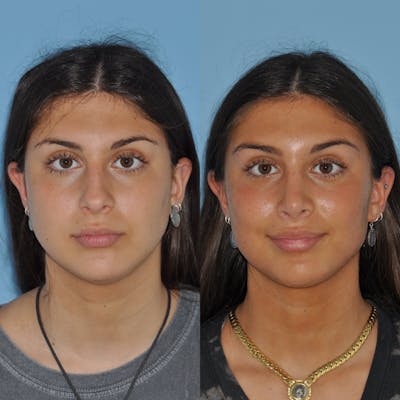 Rhinoplasty Before & After Gallery - Patient 59075289 - Image 6