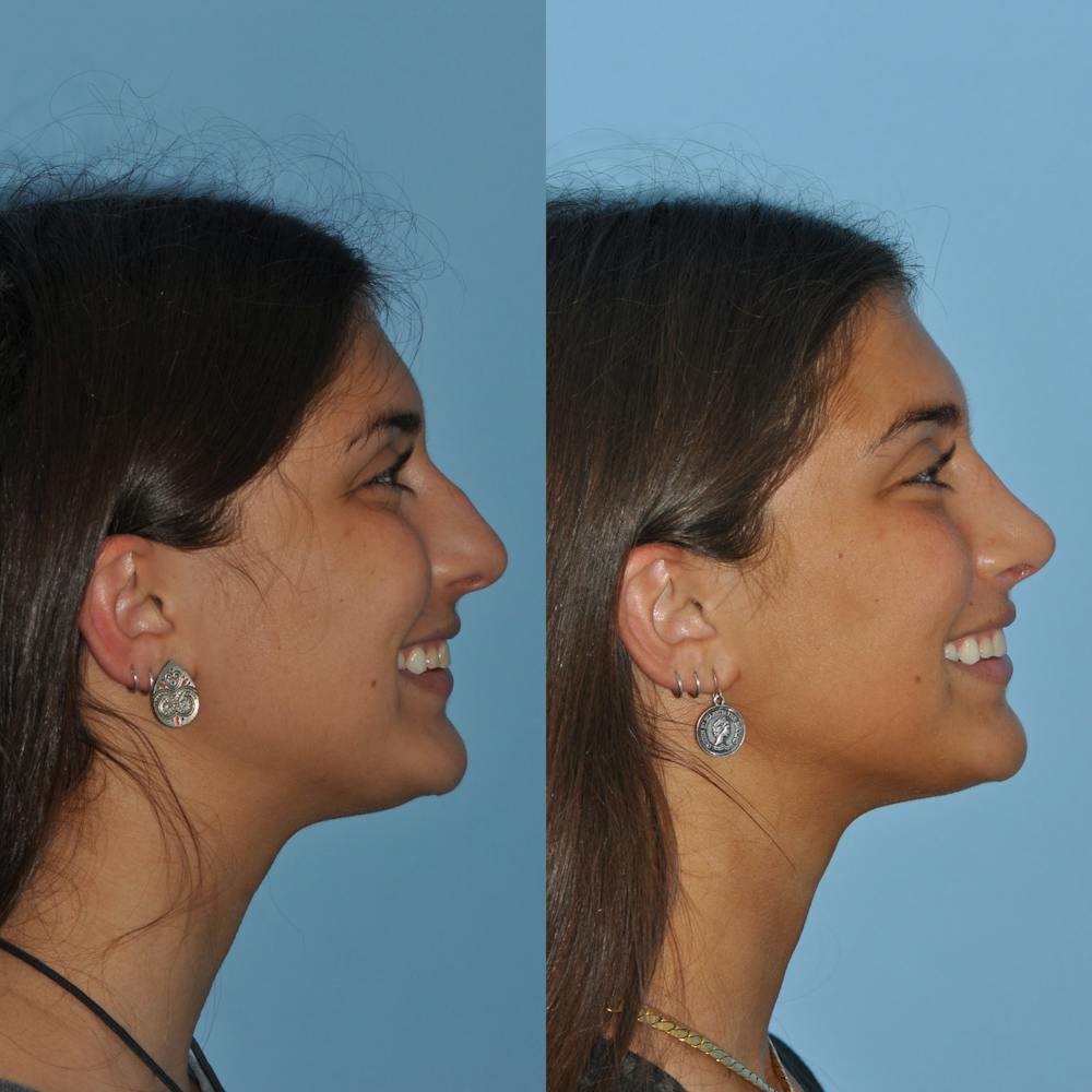 Rhinoplasty Before & After Gallery - Patient 59075289 - Image 7