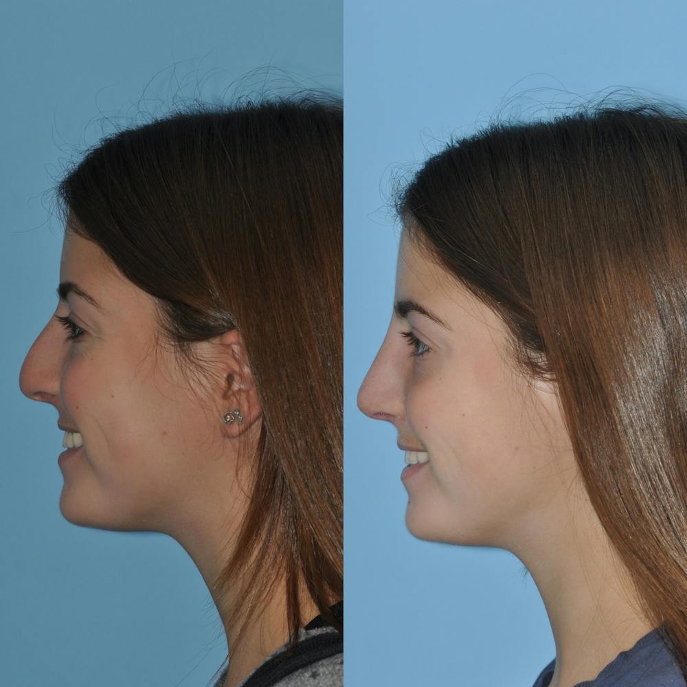 Rhinoplasty Before & After Gallery - Patient 59075290 - Image 2