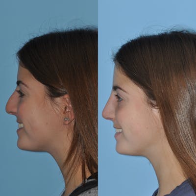 Rhinoplasty Before & After Gallery - Patient 59075290 - Image 2