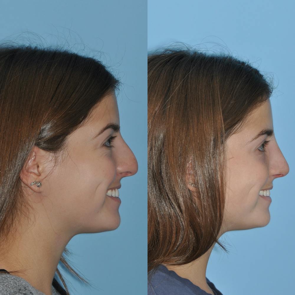 Rhinoplasty Before & After Gallery - Patient 59075290 - Image 3