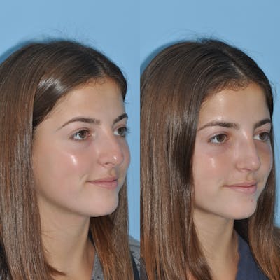 Rhinoplasty Before & After Gallery - Patient 59075290 - Image 4