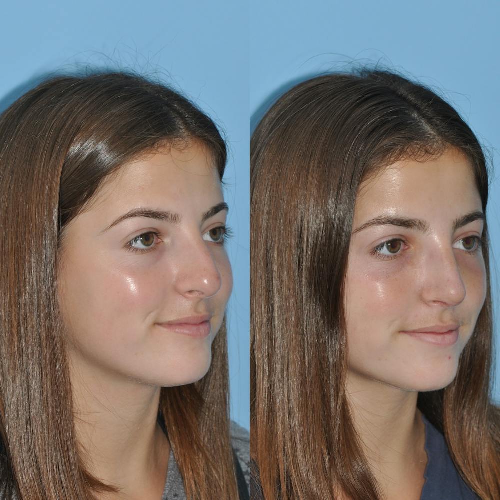 Rhinoplasty Before & After Gallery - Patient 59075290 - Image 4