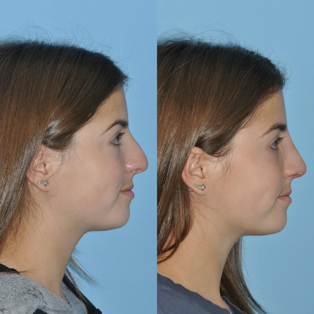 Rhinoplasty Before & After Gallery - Patient 59075290 - Image 5