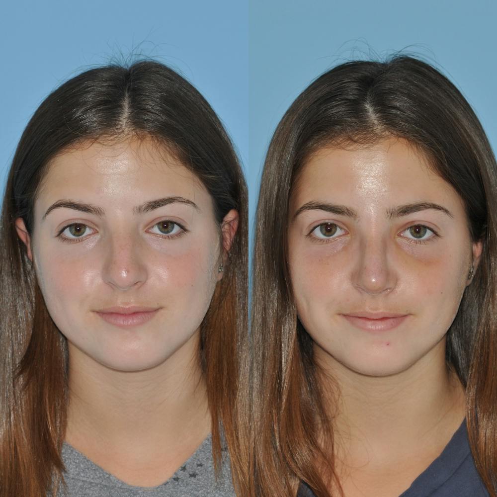 Rhinoplasty Before & After Gallery - Patient 59075290 - Image 6