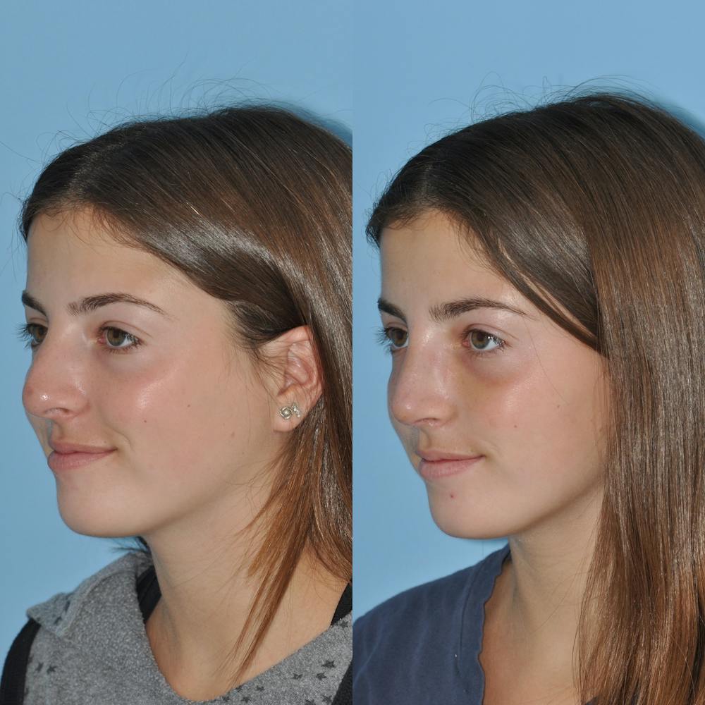 Rhinoplasty Before & After Gallery - Patient 59075290 - Image 7