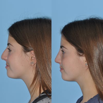 Rhinoplasty Before & After Gallery - Patient 59075290 - Image 8