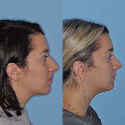 Rhinoplasty Before & After Gallery - Patient 59075291 - Image 2