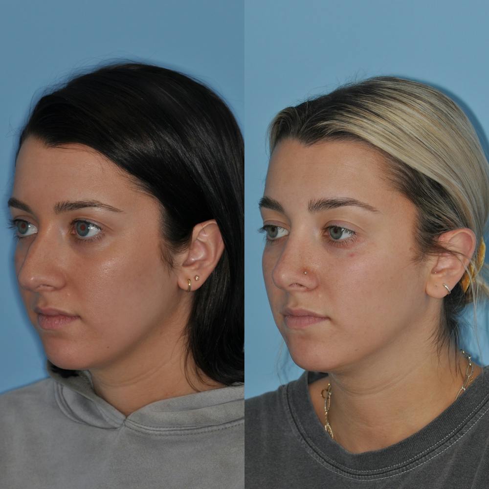 Rhinoplasty Before & After Gallery - Patient 59075291 - Image 3