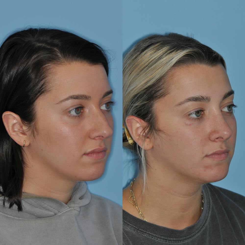Rhinoplasty Before & After Gallery - Patient 59075291 - Image 4