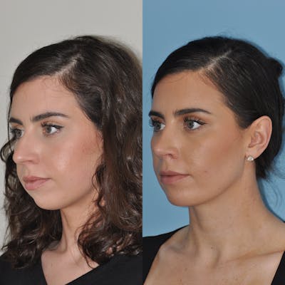 Rhinoplasty Before & After Gallery - Patient 59075292 - Image 1