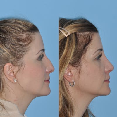 Rhinoplasty Before & After Gallery - Patient 59075293 - Image 1