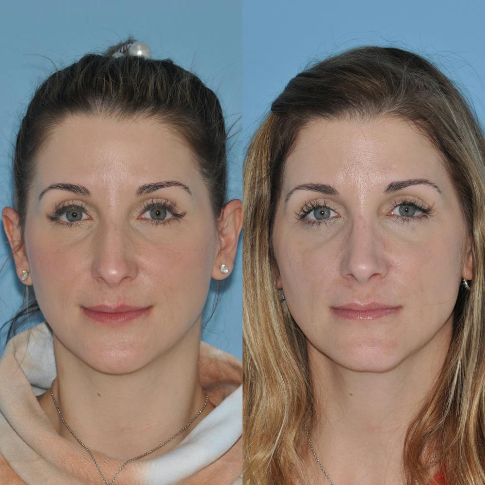 Rhinoplasty Before & After Gallery - Patient 59075293 - Image 2