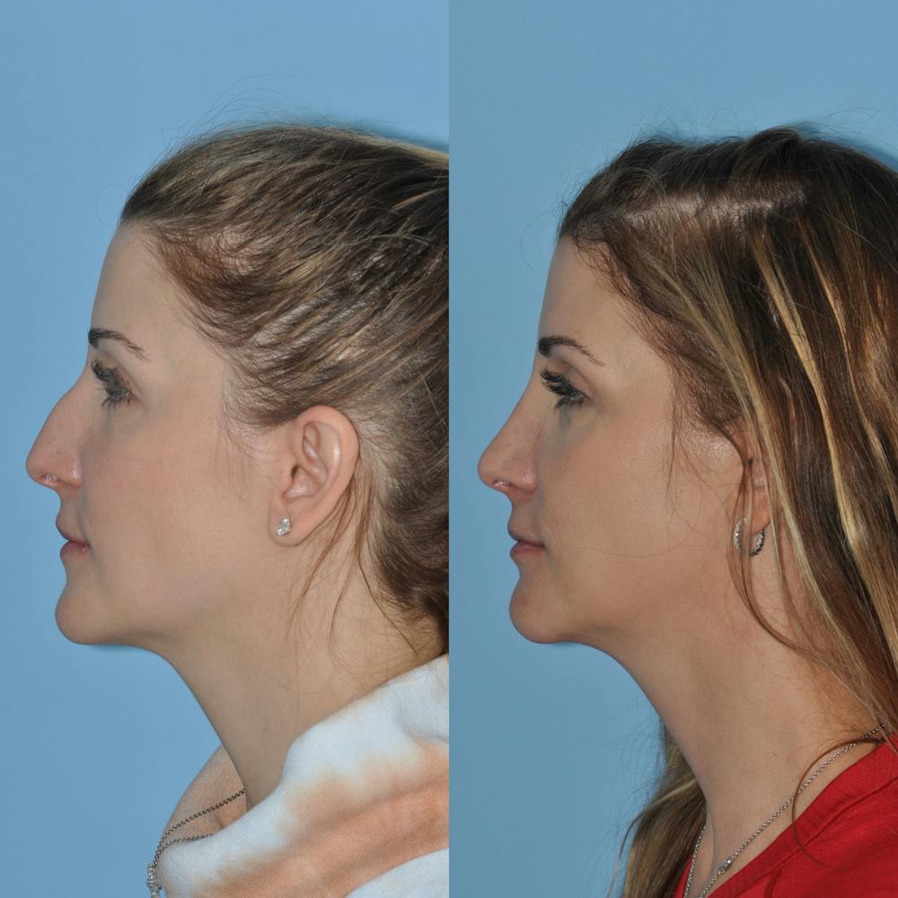 Rhinoplasty Before & After Gallery - Patient 59075293 - Image 3