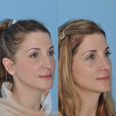 Rhinoplasty Before & After Gallery - Patient 59075293 - Image 4