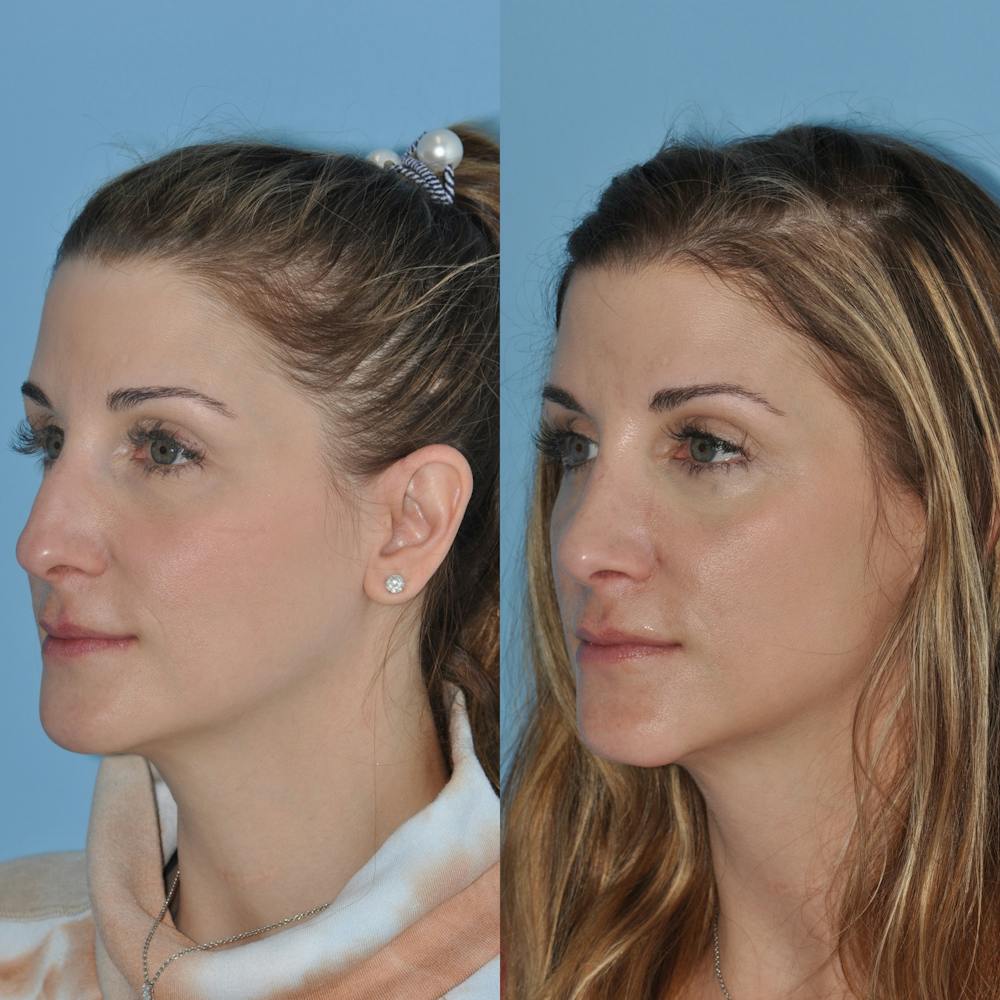 Rhinoplasty Before & After Gallery - Patient 59075293 - Image 5