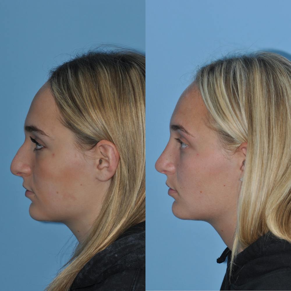 Rhinoplasty Before & After Gallery - Patient 59075294 - Image 1