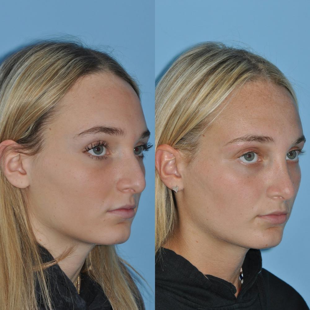 Rhinoplasty Before & After Gallery - Patient 59075294 - Image 2