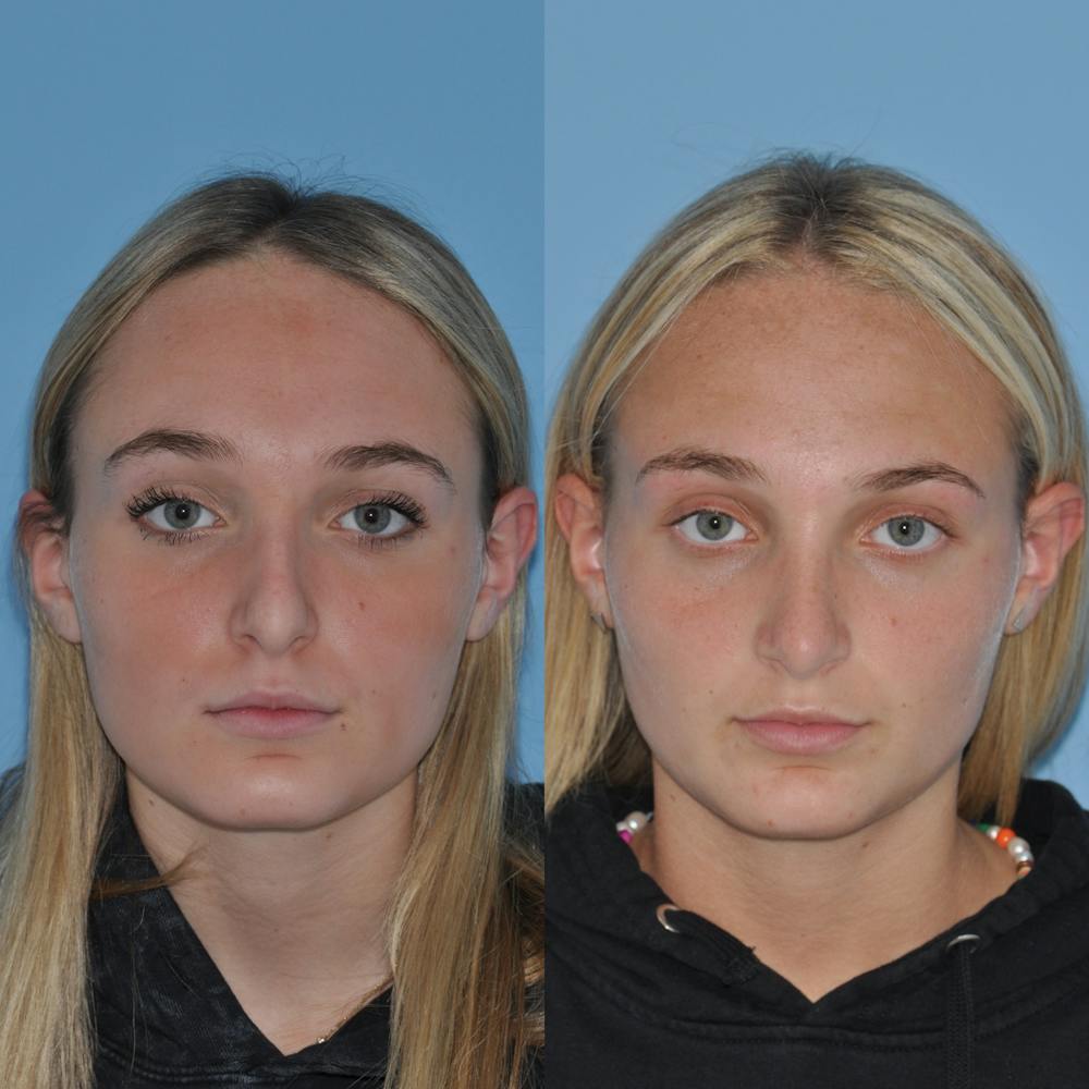 Rhinoplasty Before & After Gallery - Patient 59075294 - Image 3