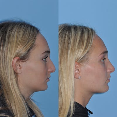 Rhinoplasty Before & After Gallery - Patient 59075294 - Image 4