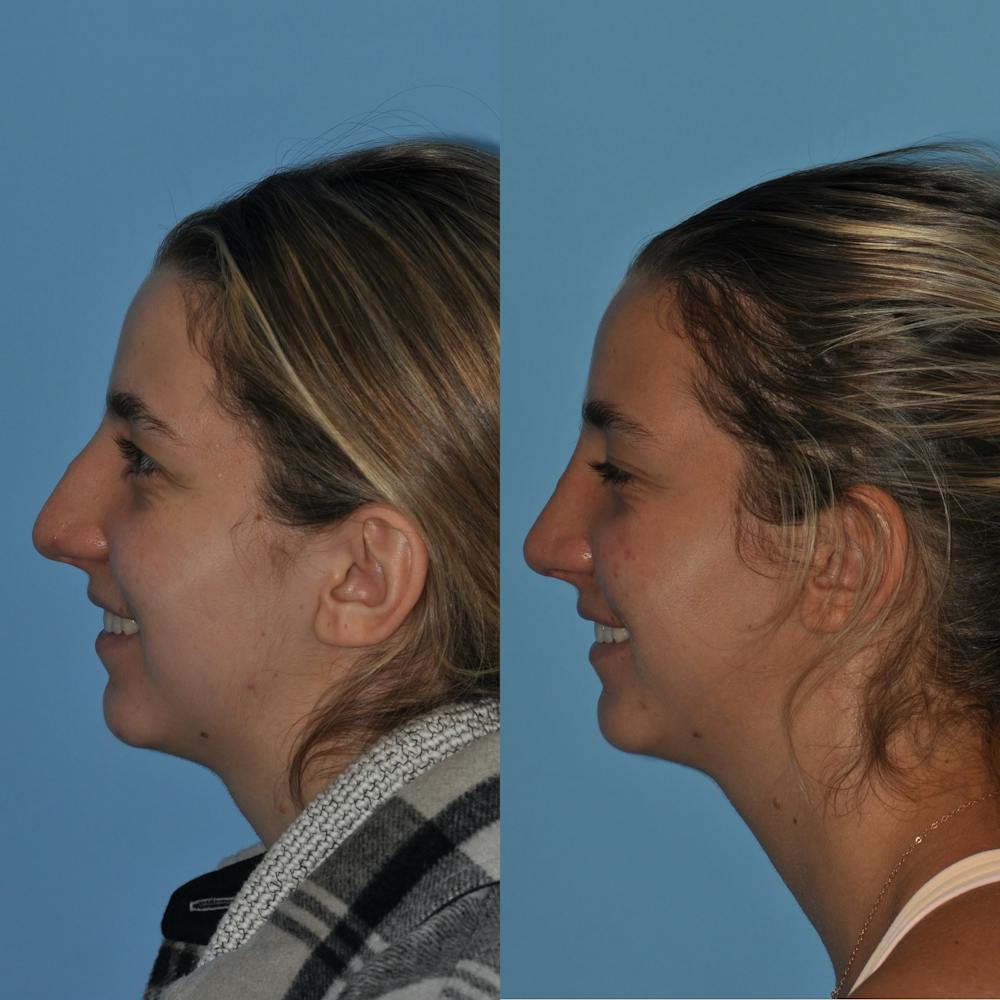 Rhinoplasty Before & After Gallery - Patient 59075295 - Image 1