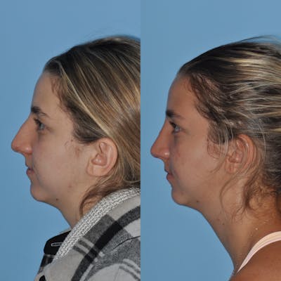 Rhinoplasty Before & After Gallery - Patient 59075295 - Image 2