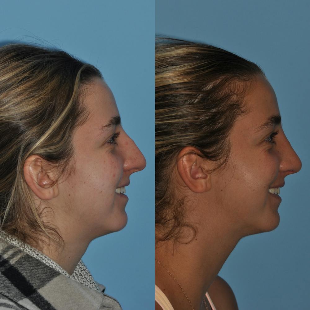 Rhinoplasty Before & After Gallery - Patient 59075295 - Image 4