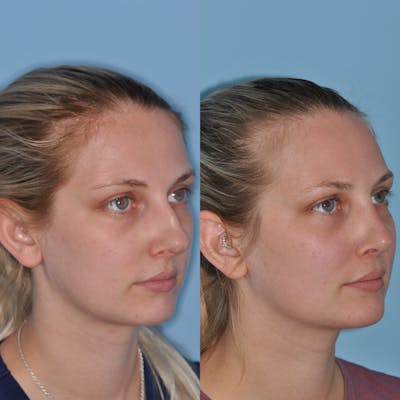 Rhinoplasty Before & After Gallery - Patient 59075296 - Image 2