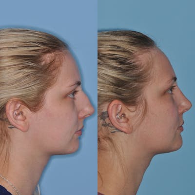 Rhinoplasty Before & After Gallery - Patient 59075296 - Image 4